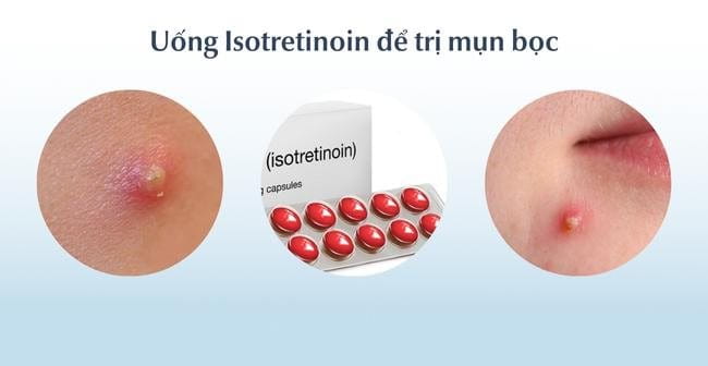 Uống Isotretinoin để trị mụn bọc