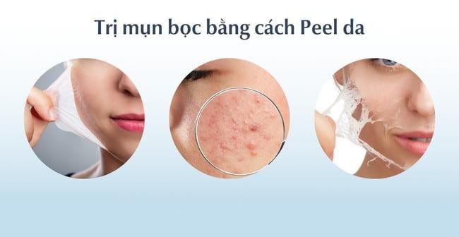 Peel da trị mụn bọc