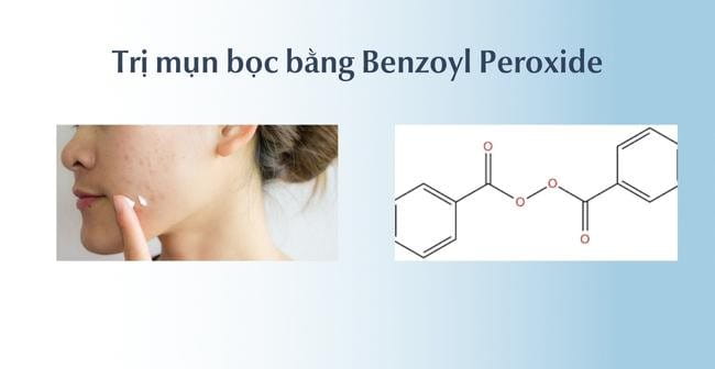 Cách trị mụn bọc tại nhà với Benzoyl Peroxide