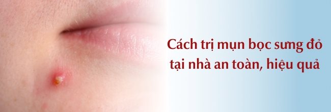 Cách trị mụn bọc sưng đỏ tại nhà an toàn, hiệu quả