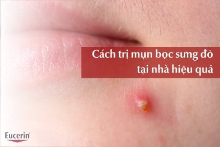 Cách trị mụn bọc tại nhà an toàn, hiệu quả