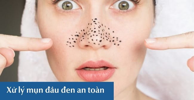 Xử lý mụn đầu đen an toàn, hiệu quả