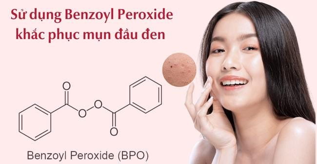 Sử dụng Benzoyl Peroxide khắc phục mụn đầu đen và thu nhỏ lỗ chân lông