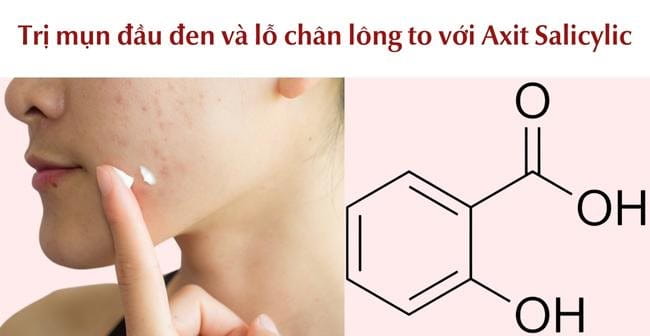 cách trị mụn đầu đen và lỗ chân lông to với Axit Salicylic