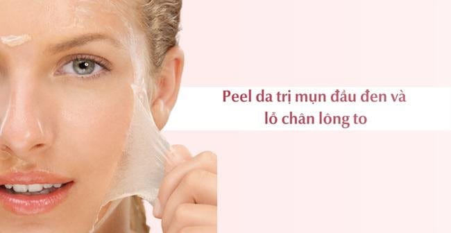 Cách trị mụn đầu đen và lỗ chân lông to bằng phương pháp peel da