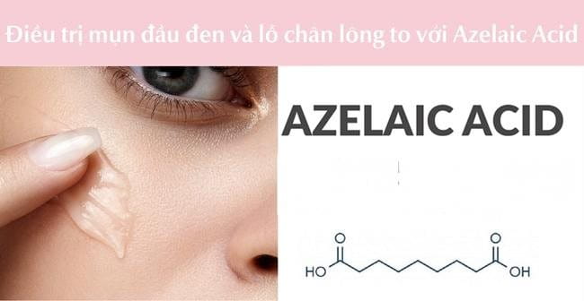 Cách trị mụn đầu đen và lỗ chân lông to với Axit Azelaic