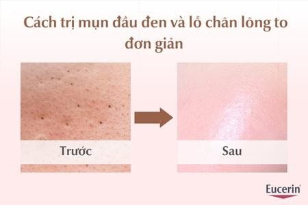 Cách trị mụn đầu đen và lỗ chân lông to đơn giản, hiệu quả tại nhà