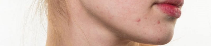 mụn dị ứng da mặt