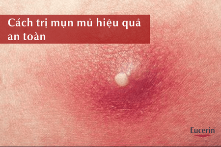 Các cách trị mụn mủ hiệu quả, an toàn