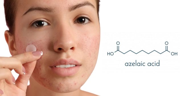 Hết mụn dậy thì với Azelaic Acid
