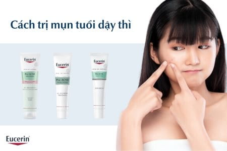 Cách trị mụn tuổi dậy thì 
