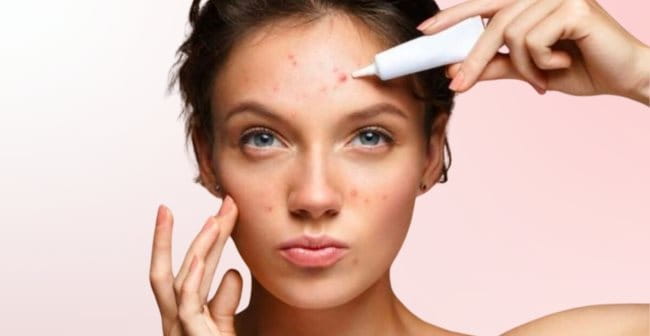 Sử dụng kem thoa/tinh chất serum trị mụn