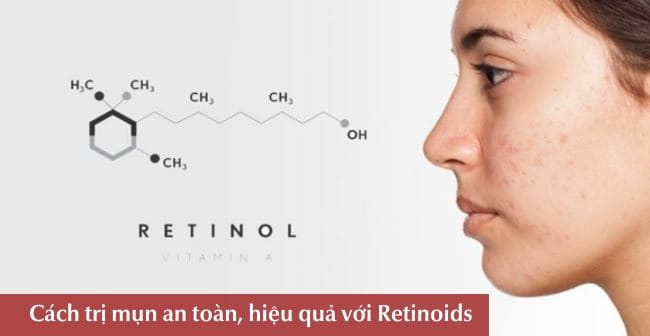 Cách trị mụn an toàn, hiệu quả với Retinoids