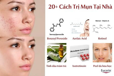20+ cách trị mụn tại nhà đơn giản dễ thực hiện