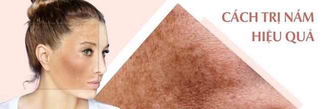 cách trị nám da tốt nhất hiện nay