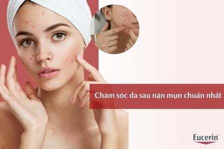Chăm sóc da sau nặn mụn đúng cách, giảm thâm sẹo cho da