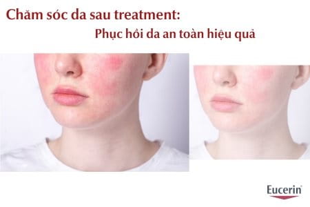 Cách Chăm Sóc Da Sau Treatment Đúng Chuẩn Giúp Phục Hồi Da Hiệu Quả