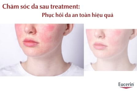 Cách Chăm Sóc Da Sau Treatment Đúng Chuẩn Giúp Phục Hồi Da Hiệu Quả