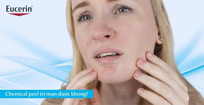 Chemical peel trị mụn