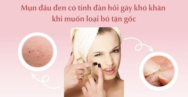 Tính đàn hồi của mụn đầu đen gây khó khăn trong việc loại bỏ tận gốc