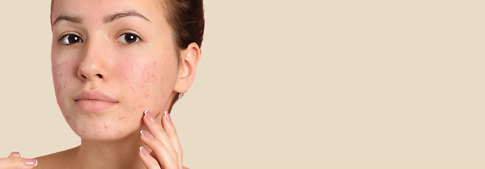 có nên nặn mụn không