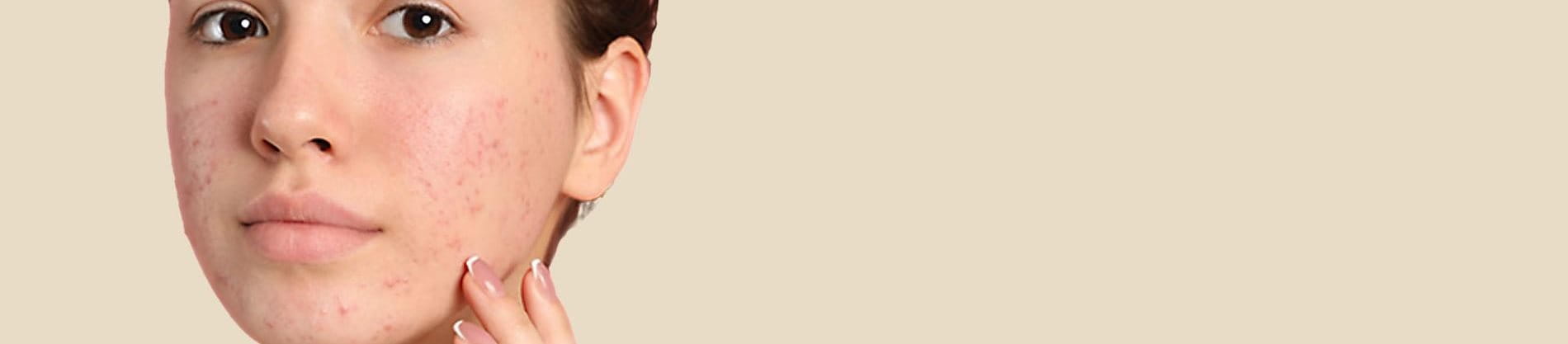 có nên nặn mụn không