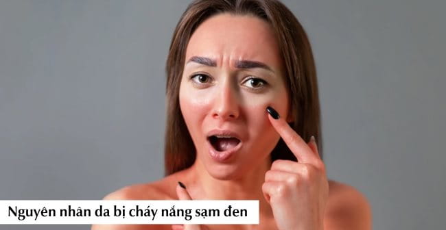 Nguyên nhân da bị cháy nắng sạm đen