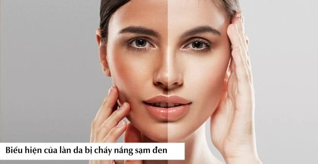 Biểu hiện của làn da bị cháy nắng sạm đen