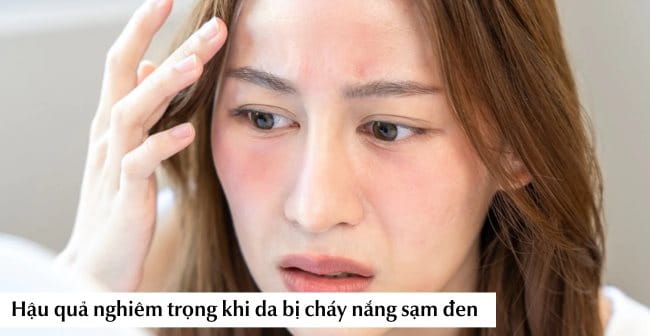 Hậu quả nghiêm trọng khi da bị cháy nắng sạm đen