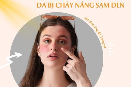 Da bị cháy nắng sạm đen phải làm sao? Cách phục hồi da cháy nắng đơn giản tại nhà