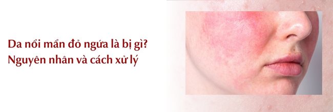  Da Bị Nổi Mẩn Đỏ Ngứa Là Bị Gì? Nguyên Nhân Và Cách Xử Lý hiệu quả