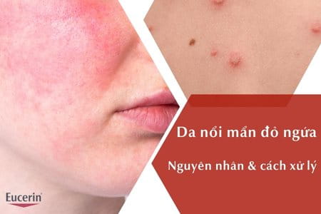 Da Bị Nổi Mẩn Đỏ Ngứa Là Bị Gì? Nguyên Nhân Và Cách Xử Lý 