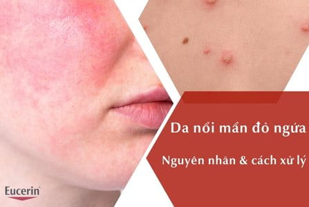 Da Bị Nổi Mẩn Đỏ Ngứa Là Bị Gì? Nguyên Nhân Và Cách Xử Lý