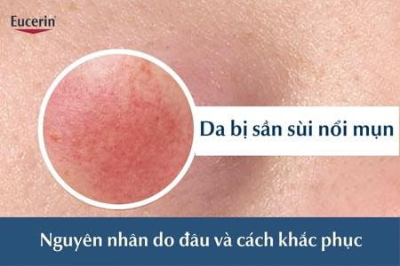 Da bị sần sùi nổi mụn nguyên nhân do đâu, cách khắc phục