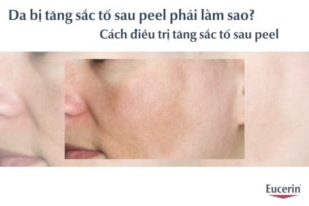Da bị tăng sắc tố sau peel phải làm sao, cách điều trị