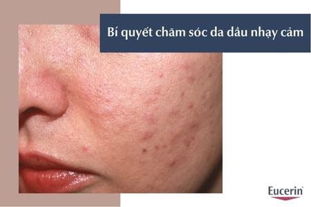 Bí quyết chăm sóc da dầu nhạy cảm đúng cách, hiệu quả