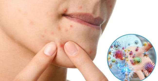 Thường xuyên dùng tay nặn mụn khiến da dễ bị nhiễm trùng