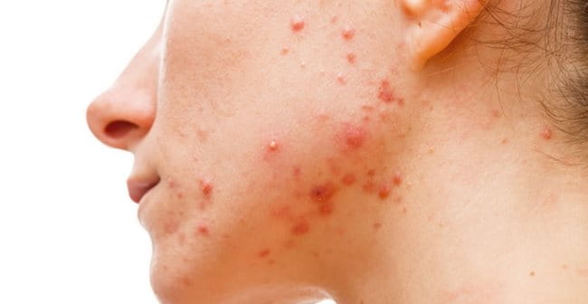 Mụn nội tiết trên da khô vào giai đoạn dậy thì