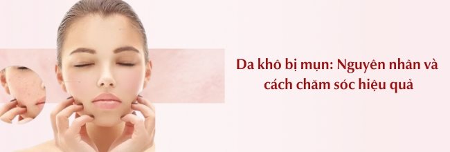Da khô bị mụn: Nguyên nhân, cách chăm sóc