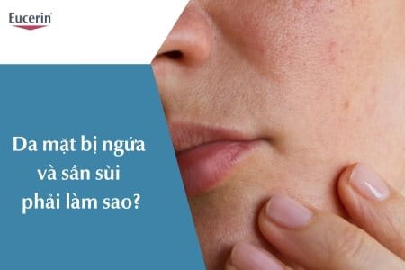 Da mặt bị ngứa và sần sùi