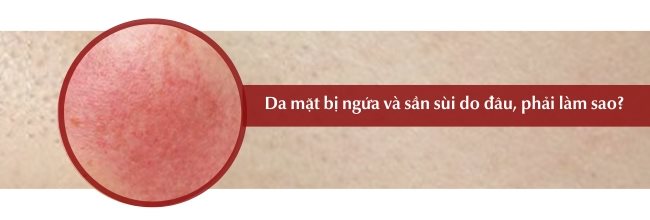 Da mặt bị ngứa và sần sùi