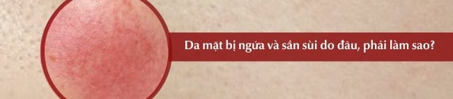 Da mặt bị ngứa và sần sùi