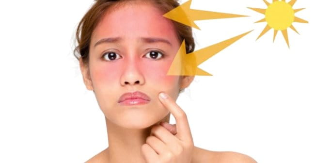 Da trở nên nhạy cảm hơn với tia UV