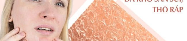 Da sần sùi, da thô ráp dễ bị bong tróc