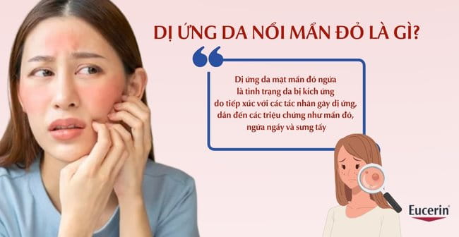 Dị ứng da mặt mẩn đỏ ngứa là gì?