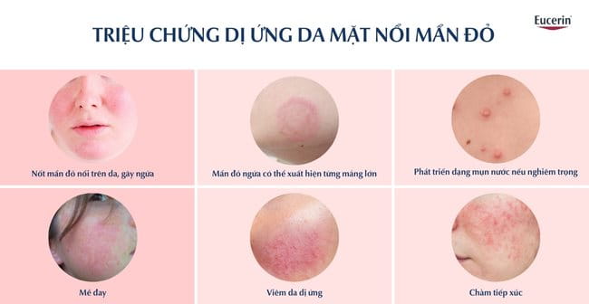 Biểu hiện của dị ứng da mặt nổi mẩn đỏ và ngứa