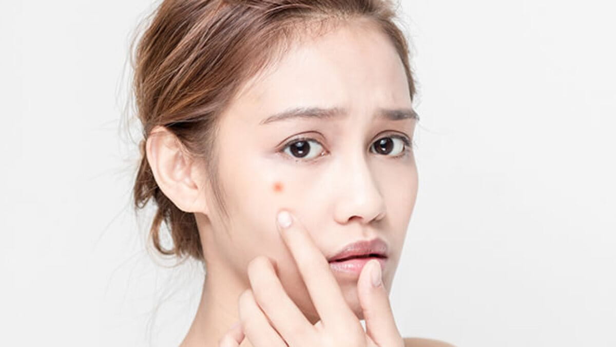 dược mỹ phẩm trị mụn