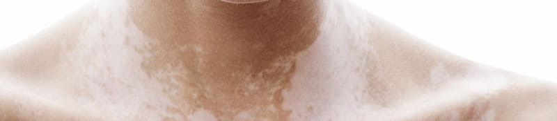 giảm sắc tố melanin