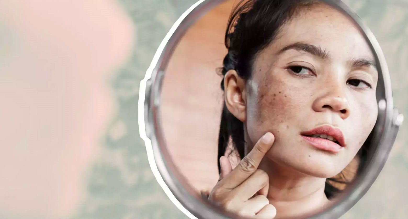 nguyên nhân gây nám da