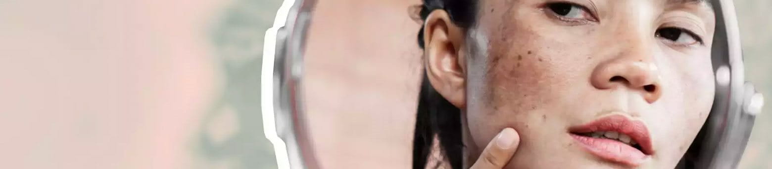 nguyên nhân gây nám da